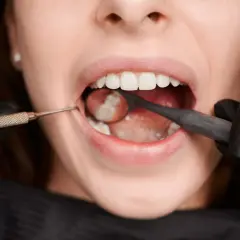 Dentysta w czarnej rękawiczce używa lusterka i narzędzia do kontroli zębów, przygotowując się do usuwania ósemek.