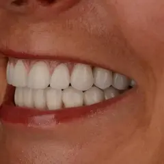 Olśniewający uśmiech po wybielaniu zębów lampą Beyond. Piękne, białe zęby i lśniące usta.