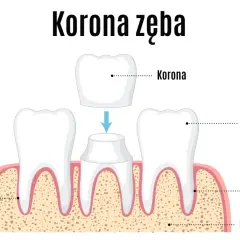 Ilustracja pokazuje proces zakładania korony na ząb. Dowiedz się, jaka jest odbudowa zęba jedynki cena.