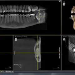 Planowanie wyrywania ósemki na podstawie tomografii komputerowej szczęki. Widok 3D i przekroje zębów.