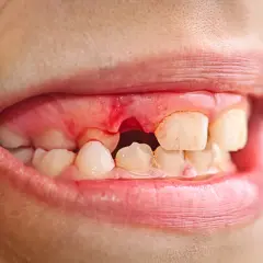 Usta z widocznym krwawieniem dziąseł i pustym miejscem po wybitym zębie.