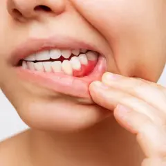 Spuchnięte dziąsło? Szybka ulga i domowe sposoby kiedy do dentysty