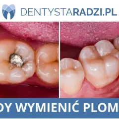 Porównanie zęba ze starą plombą amalgamatową i nowym wypełnieniem. Dowiedz się, ile kosztuje srebrny ząb i kiedy go wymienić.
