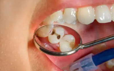 Widok lusterka dentystycznego ukazujący zęby z widoczną głęboką próchnicą.