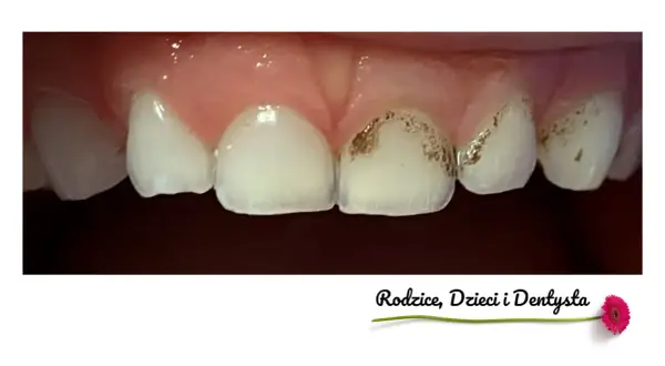 Zbliżenie na zęby dziecka z widocznymi przebarwieniami, które mogą wskazywać na próchnicę. Czarne zęby u dzieci to sygnał do wizyty u dentysty.