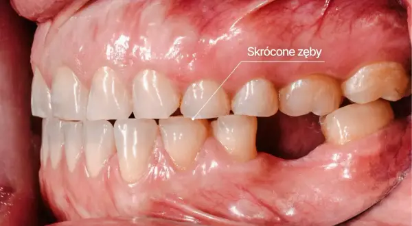 Zgrzytanie zębami w nocy może prowadzić do skrócenia zębów, jak widać na zdjęciu. Widoczne są starte zęby i ubytek w dolnym łuku.