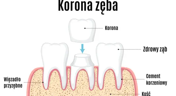 Ilustracja pokazuje proces zakładania korony na ząb. Dowiedz się, jaka jest odbudowa zęba jedynki cena.