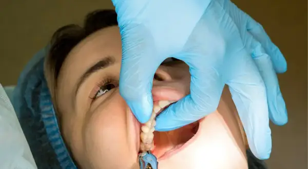 Dentysta w niebieskiej rękawiczce delikatnie wyciąga szwy z ust pacjentki. Czy ściąganie szwów boli?