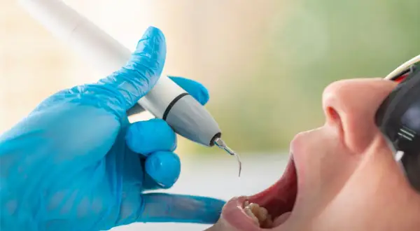 Dentysta w niebieskiej rękawiczce używa ultradźwiękowego skalera. Czy usuwanie kamienia boli? Zabieg jest zazwyczaj bezbolesny.