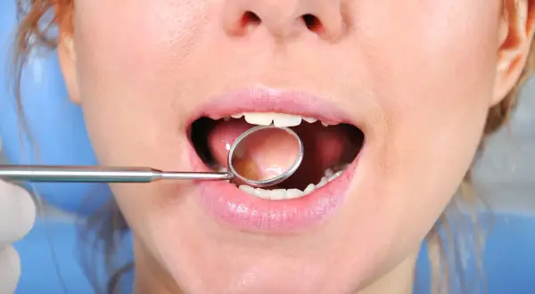 Usta kobiety z lusterkiem dentystycznym, badanie złamanego zęba przy dziąśle. Cena zabiegu może być różna.