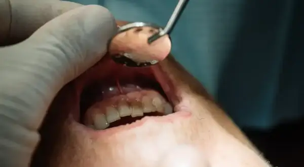 Dentysta bada zęby, szukając przyczyny bólu. Może to być zapalenie wymagające antybiotyku na zęba.
