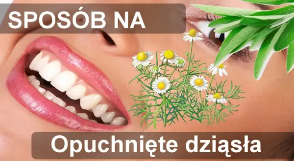 Opuchnięte dziąsła: Szybka ulga i skuteczne sposoby (domowe i apteczne)