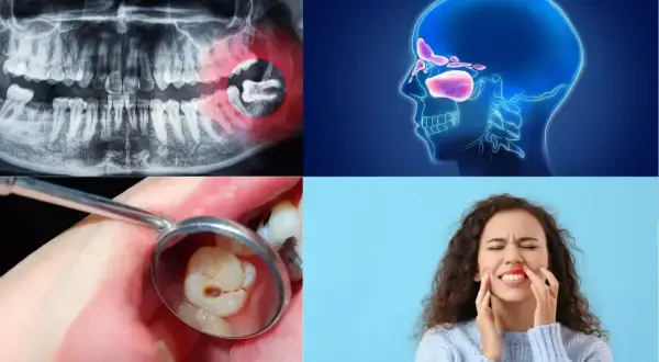 RTG szczęki, zatoki, ząb w lustrze dentystycznym i kobieta z bólem zęba. Jak uśmierzyć ból rosnący ząb mądrości?
