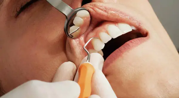 Dentysta używa narzędzi do ekstrakcji zęba. Widoczne są usta pacjenta, zęby i narzędzia stomatologiczne.
