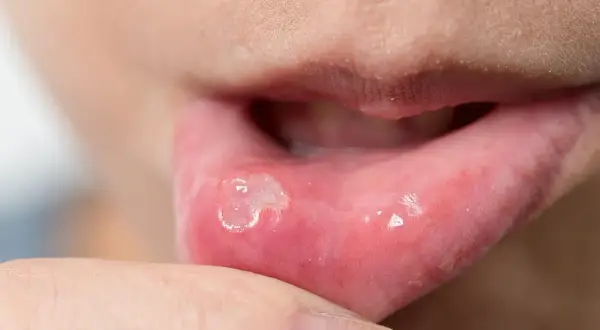 Afta u dentysty? Kiedy wizytę przełożyć, a kiedy iść?