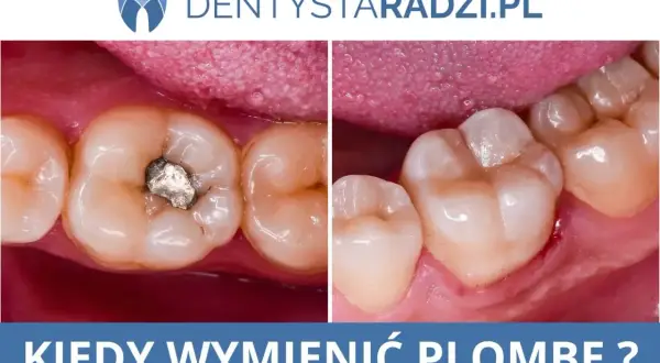 Porównanie zęba ze starą plombą amalgamatową i nowym wypełnieniem. Dowiedz się, ile kosztuje srebrny ząb i kiedy go wymienić.