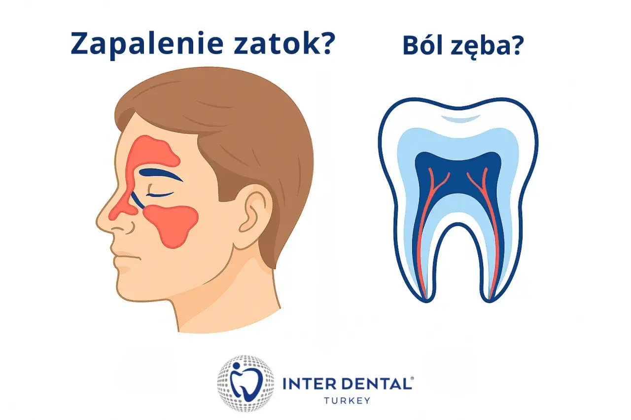 Zapalenie zatok czy tępy ból zęba? Ilustracja porównuje objawy zapalenia zatok z przekrojem zęba.