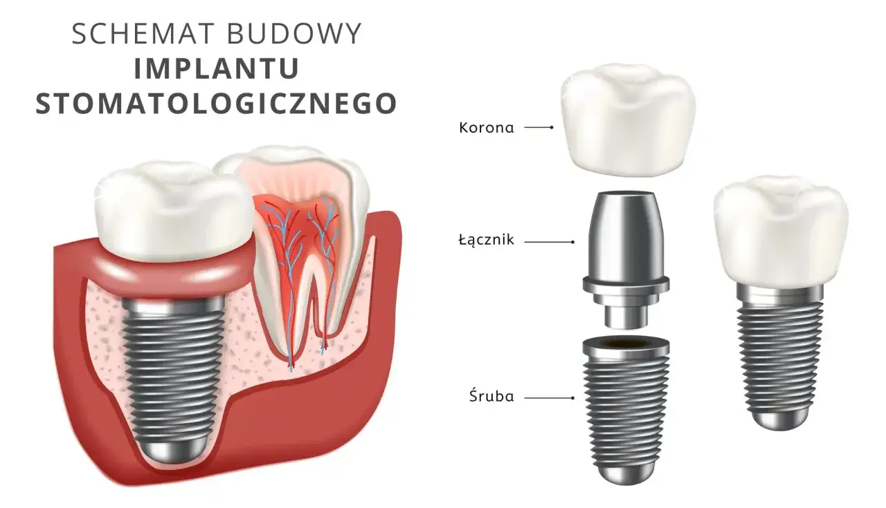 Schemat budowy implantu stomatologicznego: śruba, łącznik i korona. Zastanawiasz się, ile kosztuje srebrny ząb?
