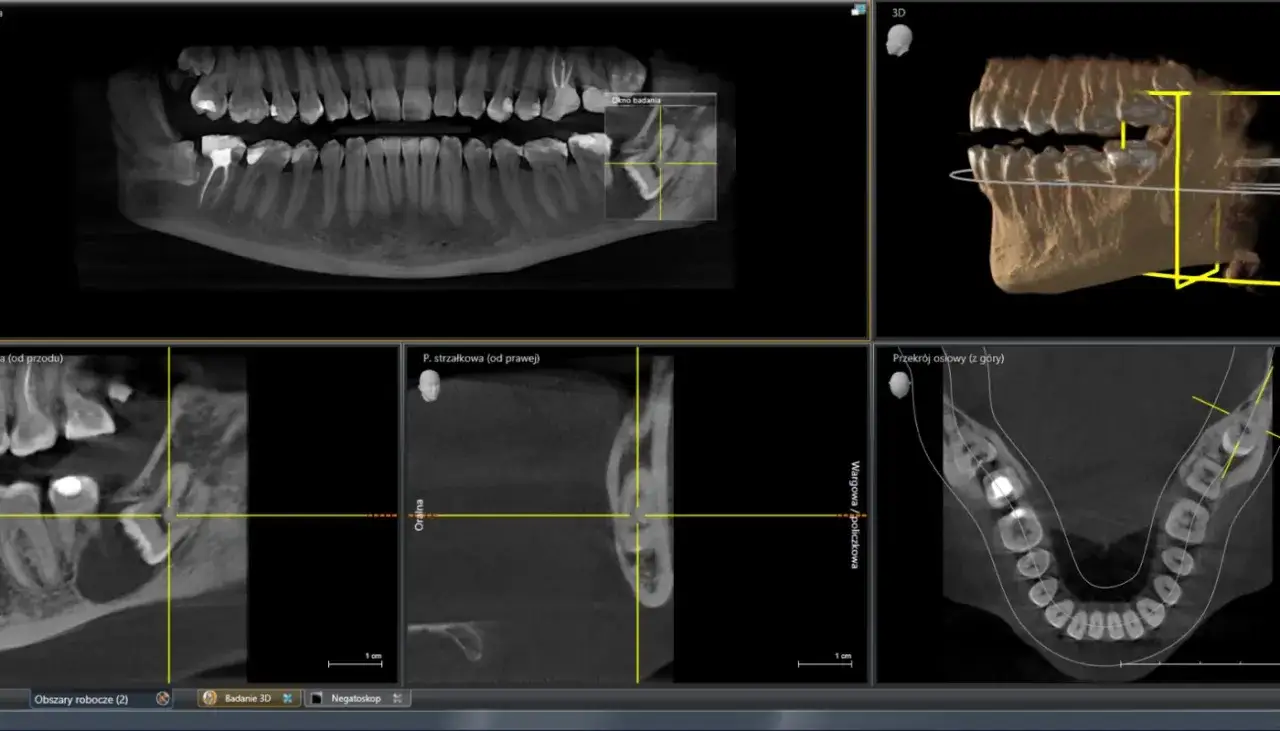 Planowanie wyrywania ósemki na podstawie tomografii komputerowej szczęki. Widok 3D i przekroje zębów.
