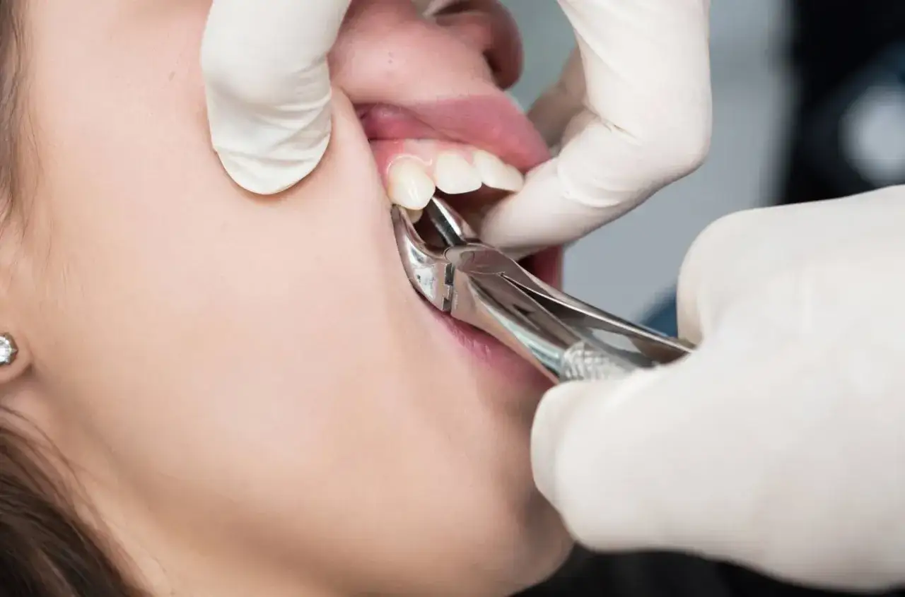 Dentysta używa kleszczy do wyrwania zęba. Zastanawiasz się, ile kosztuje wyrwanie zęba?