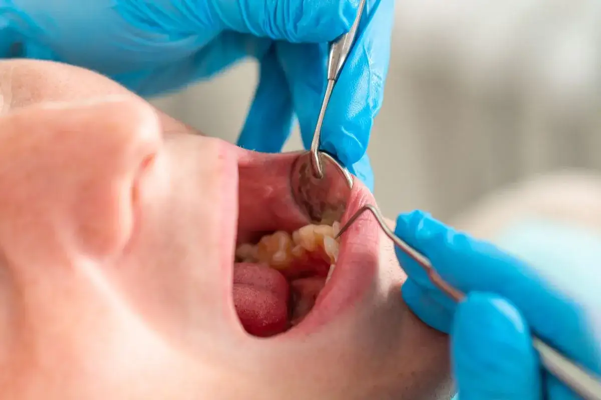 Dentysta bada zęby, by wyeliminować nieprzyjemny smród z zęba.