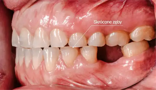 Nocne zgrzytanie zębami - Czy bruksizm jest groźny?