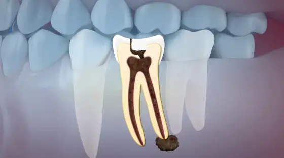 Smród z zęba - skąd się bierze i kiedy iść do dentysty