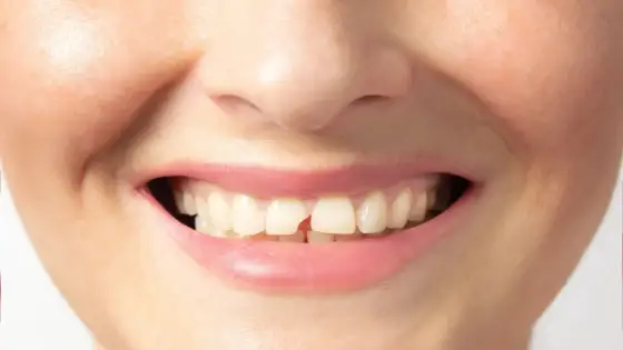 Dlaczego zęby się kruszą i kiedy trzeba iść do dentysty?