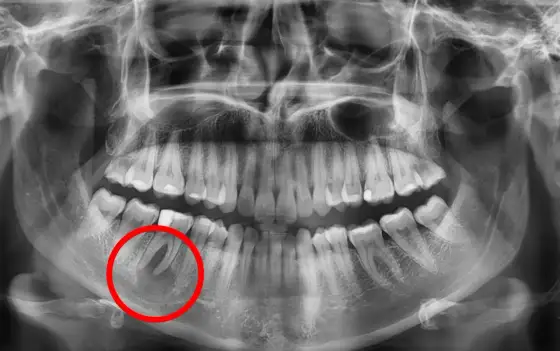 Torbiel zęba - jak złagodzić objawy i kiedy pilnie iść do dentysty