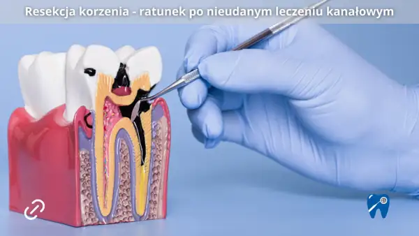 Model zęba pokazuje problem z korzeniem, gdzie narzędzie dentystyczne sugeruje resekcję wierzchołka korzenia jako rozwiązanie po nieudanym leczeniu kanałowym.