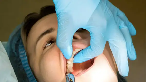 Dentysta w niebieskiej rękawiczce delikatnie wyciąga szwy z ust pacjentki. Czy ściąganie szwów boli?