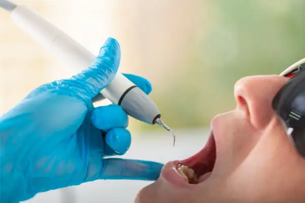 Dentysta w niebieskiej rękawiczce używa ultradźwiękowego skalera. Czy usuwanie kamienia boli? Zabieg jest zazwyczaj bezbolesny.