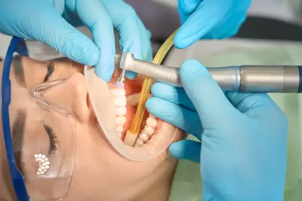 Dentysta wykonuje powtórne leczenie kanałowe, używając wiertła i ślinociągu. Pacjent ma założony koferdam i okulary ochronne.