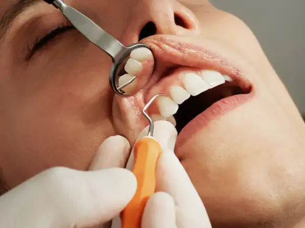 Dentysta wykonuje czyszczenie zębów u pacjenta, używając lusterka i narzędzia.