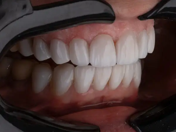 Piękne, białe zęby po leczeniu kanałowym. Zastanawiasz się, ile wytrzyma ząb po leczeniu kanałowym? Dbanie o higienę i regularne wizyty u dentysty to klucz do długowieczności.