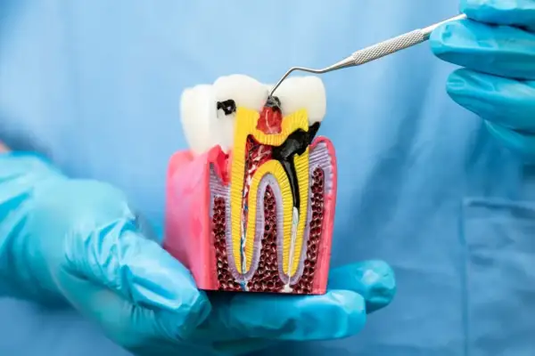 Model zęba pokazuje, ile kanałów ma 4 górna. Widać próchnicę i narzędzie dentystyczne.