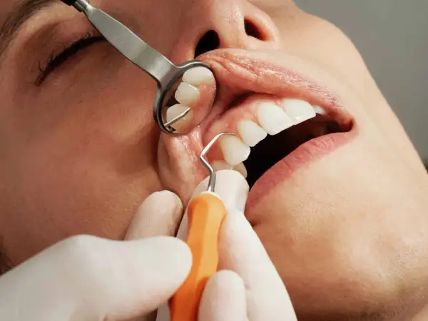 Dentysta używa narzędzi do ekstrakcji zęba. Widoczne są usta pacjenta, zęby i narzędzia stomatologiczne.